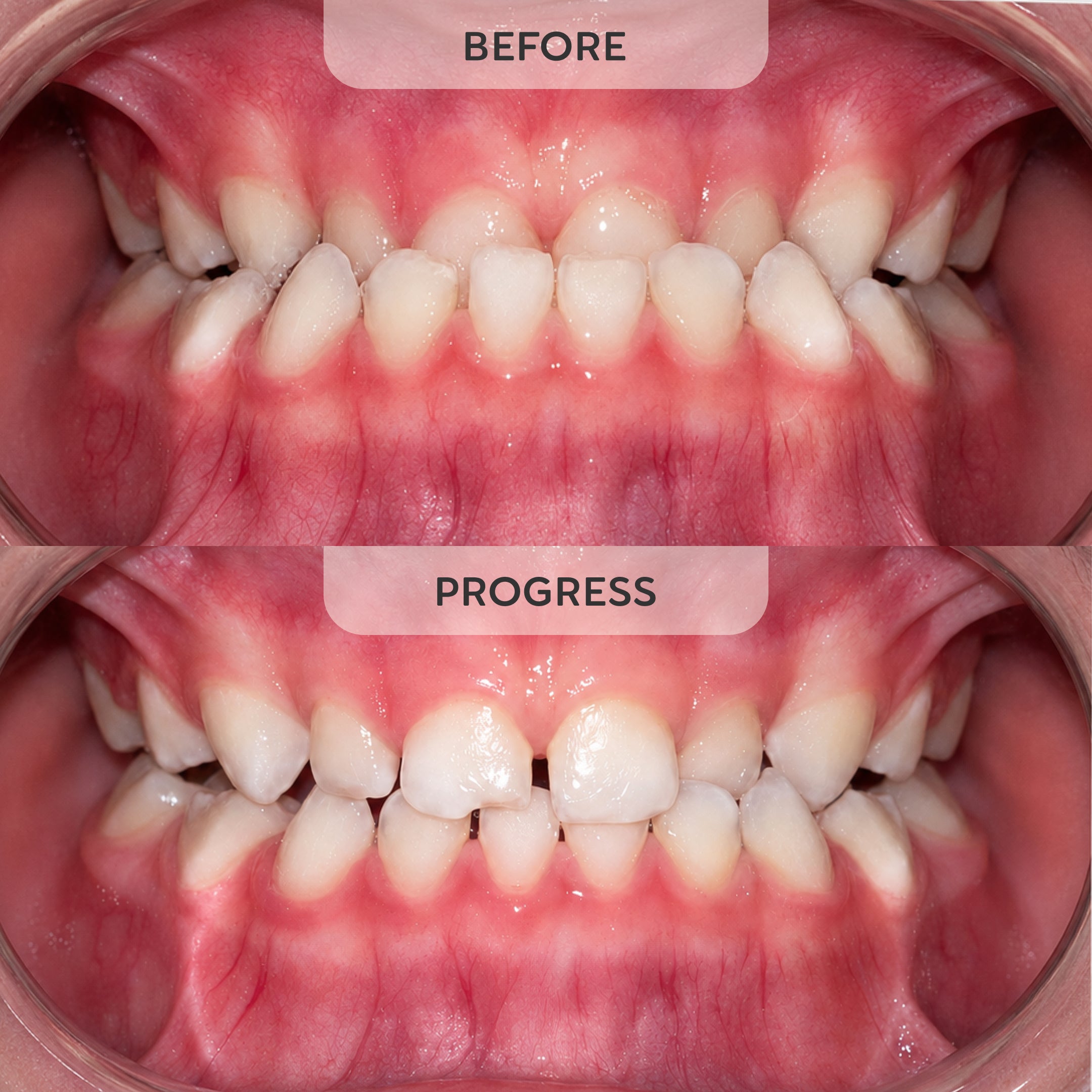 Before and progress photos after four months