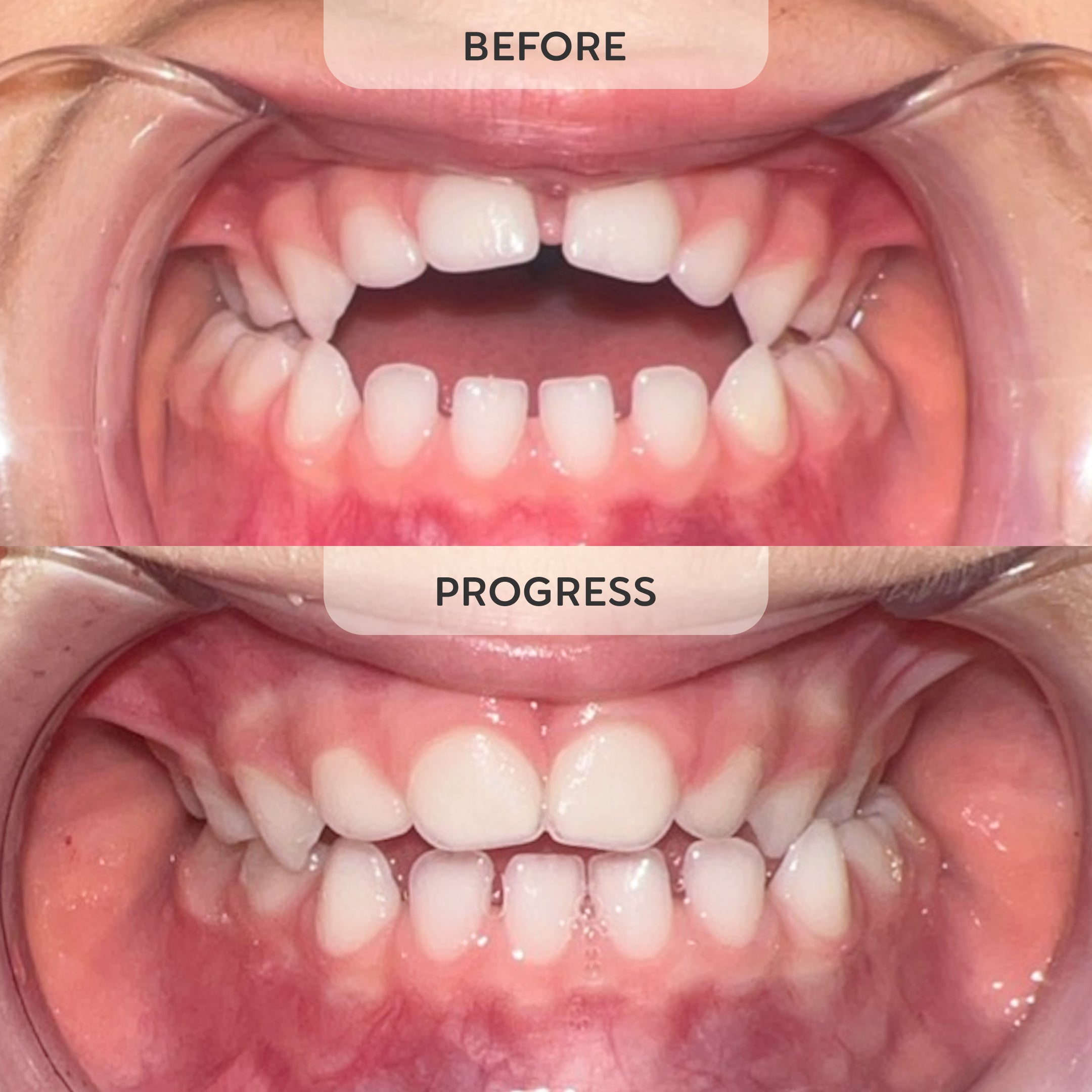 Tooth Pillow patient sleep result