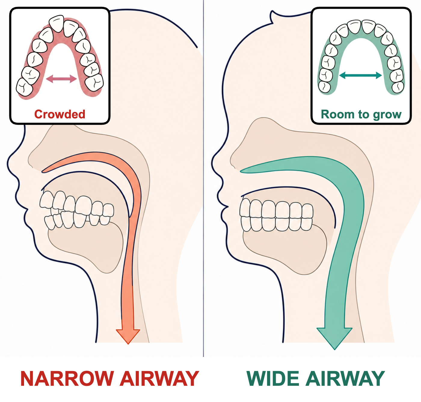 A narrow airway with a crowded dental arch versus a wide airway with room to grow